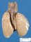 Bilateral quadrilobar lungs, dextrocardia is right isomerism with (...)