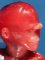 Holoprosencephaly: cyclopia, proboscis, nasal agenesis