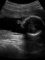 Alobar holoprosencephaly with posterior cyst