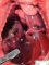 Left diaphragmatic hernia (fetus, 25 weeks)