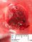 Posterior encephalocele in Meckel syndrome