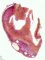 Obstructive renal dysplasia