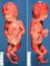 Oligohydramnios sequence in premature rupture of amniotic membrane