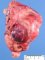 Renal malignant rhabdoid tumor