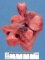 Pericardial teratoma