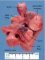 Pericardial teratoma