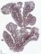 Adenoids - CD20 immunochemistry