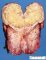 Adrenocortical carcinoma