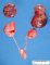 Cystic adrenal in in Beckwith-Wiedemann syndrome (fetus 27 weeks)