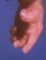 Broad thumb in a Pfeiffer syndrome