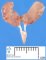 Horseshoe kidney and anorectal agenesis with rectourethral fistula