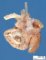 Aortic arch hypoplasia