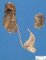 Uniateral renal agenesis in a malformative syndrome