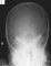 Cranial eosinophilic granuloma