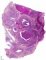 Bronchiectasis in cystic fibrosis and peribronchial inflammation in cystic (...)