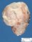 Pyelorenal duplication with cystic dilatation of the upper calix
