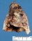 Intralobar pulmonary sequestration