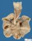 Right aortic arch and retroesophageal ductus arteriosus