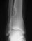 Fibrous cortical defect or non-ossifying fibroma (eMedicine)