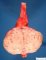 Parietal uterine leiomyoma