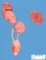 Renal hypoplasia and ectopia