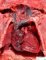 Dilated superior vena cava and right atrium