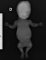 Short humerus in thanatophoric dysplasia (Fetus, 21 weeks - Case (...)