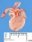 Tricuspid atresia
