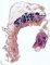 Cystic cavity and mature thymus in mature teratoma
