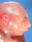 Facial anomalies associated with posterior encephalocele