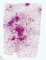 Pulmonary hemorrhages