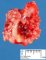 Subcutaneous abcess