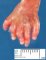 Postaxial polydactyly in trisomy 13
