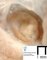 Parietal left ventricular polyp in aortic arch hypoplasia