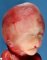 Facial dysmorphism in alobar holoprosencephaly (Case 13535)