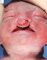 Bilateral lip/palate clefts in situs anomaly (Case 14948)