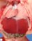 Caudal regression syndrome with lumbosacral agenesis and situs (...)