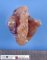 Apple peel jejunal atresia