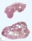 Colorectal juvenile polyp