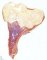 Spondylometaphyseal dysplasia