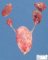 Megacystis, bilateral obstructive multicystic renal dysplasia (BOMRD) with (...)