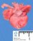 Bilateral pulmonary hypoplasia in oligohydramnios sequence