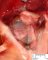 Renal adysplasia (case 11385)