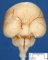 Alobar holoprosencephaly (Case 12063)
