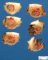 Abcessed pilonidal sinus cyst