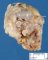 Femoral osteochondroma