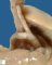 Right aortic arch and retroesophageal ductus arteriosus