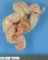 NF1-associated plexiform neurofibroma