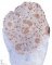CD20+ nodules in progreesive transformation of germinal centers (...)