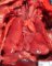 Pulmonary artery hypoplasia with right aorta
